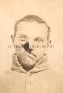 Mercury poisoning deformity. Severe facial deformity in the case of US soldier Carleton Burgan (1844-1915). Burgan was serving with Union forces (Maryland's Purnell Legion) during the US Civil War, when he was treated in August 1862 for pneumonia. The mercury-based drug used was calomel. An ulcer developed on the tongue that spread and destroyed his upper mouth, palate, right cheek and right eye. The cheekbone was removed to prevent further spread of the 'mercurial gangrene'. In 1865, Burgan's face was reconstructed in pioneering work by US plastic surgeon Gurdon Buck (1807-1877). For the reconstruction, see C011/4360.